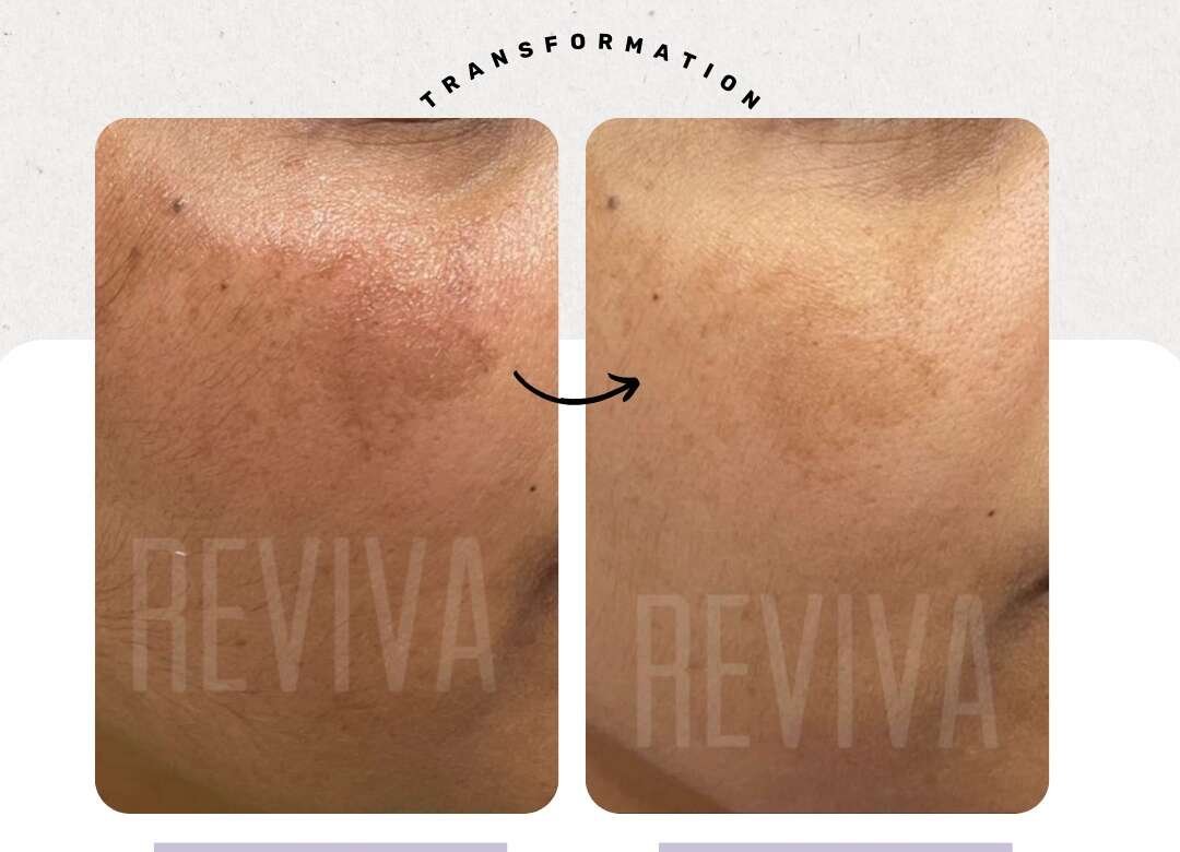 What Skin Conditions Are Treated at Reviva Skin & Surgery Clinic in Noida?