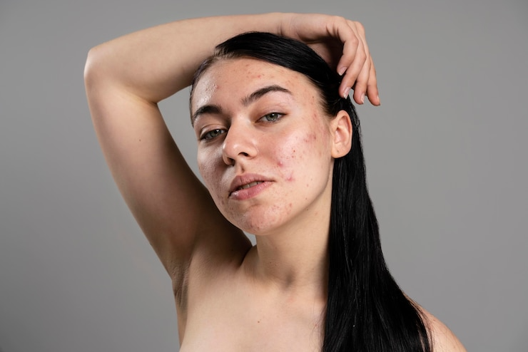 What Is the Best Acne Scars Removal Treatment Available in Noida?