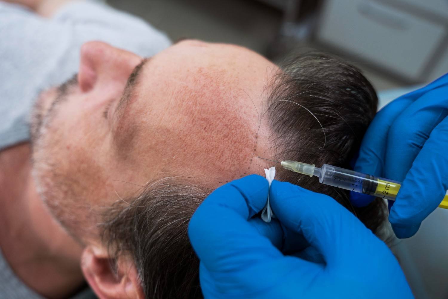How Long Does It Take to See Results After a Hair Transplant?