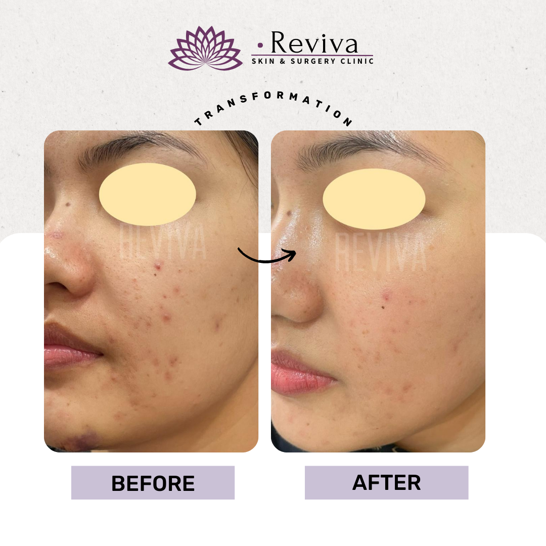 Pigmentation treatment before and after
