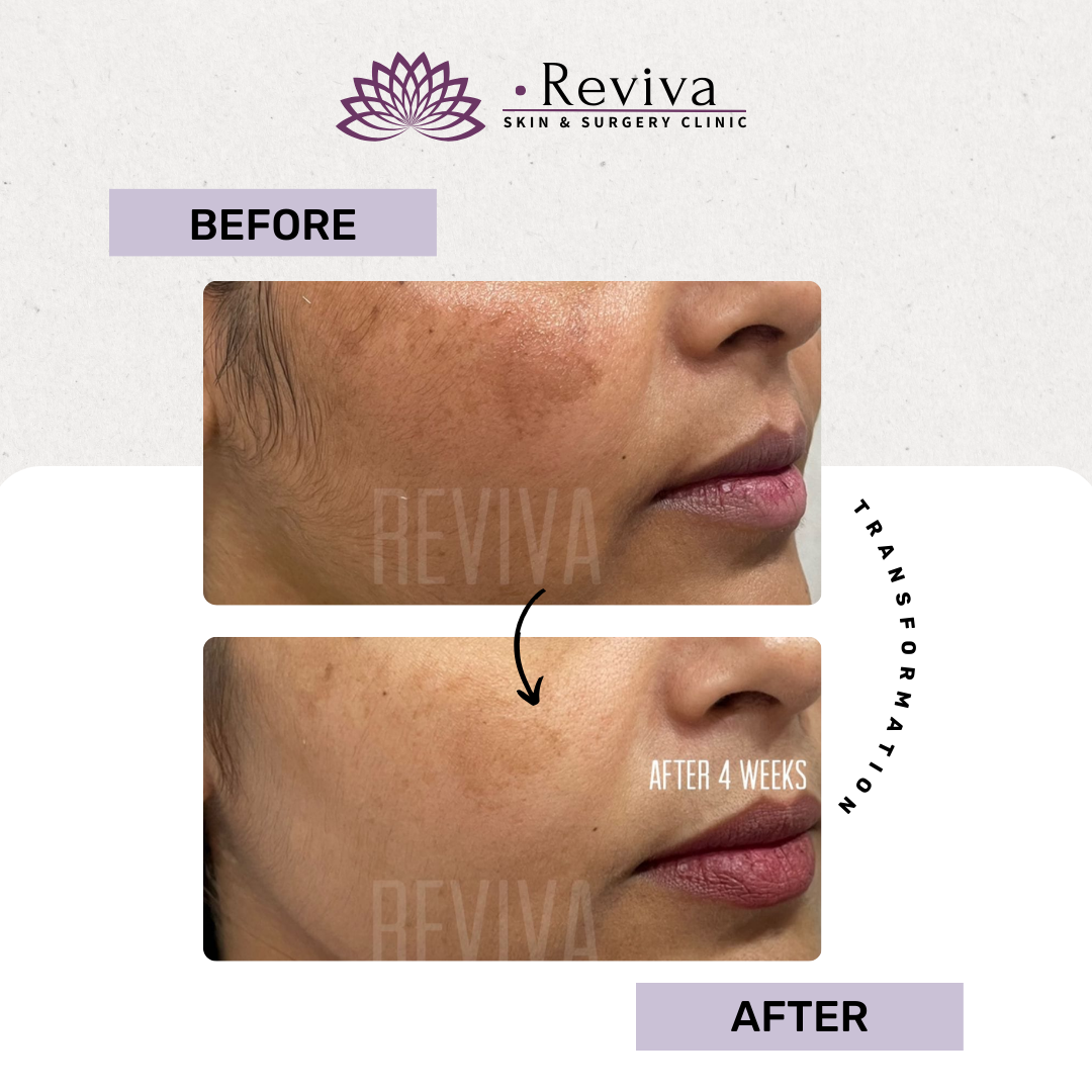Pigmentation treatment before and after