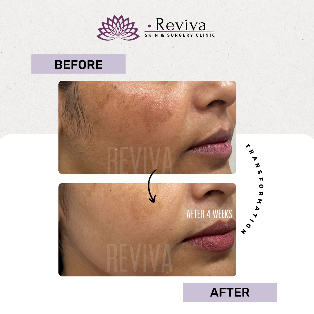Pigmentation treatment before and after