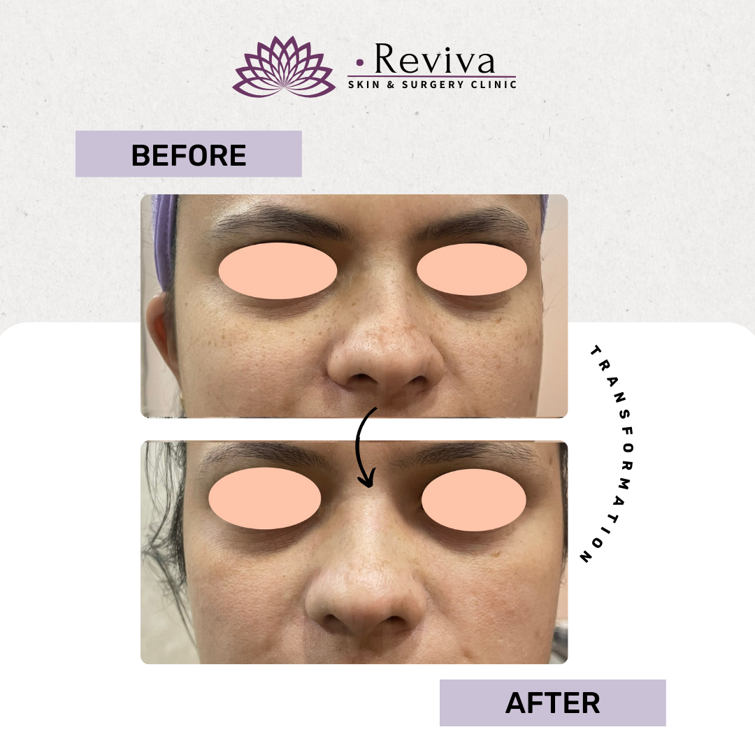 Pigmentation treatment before and after
