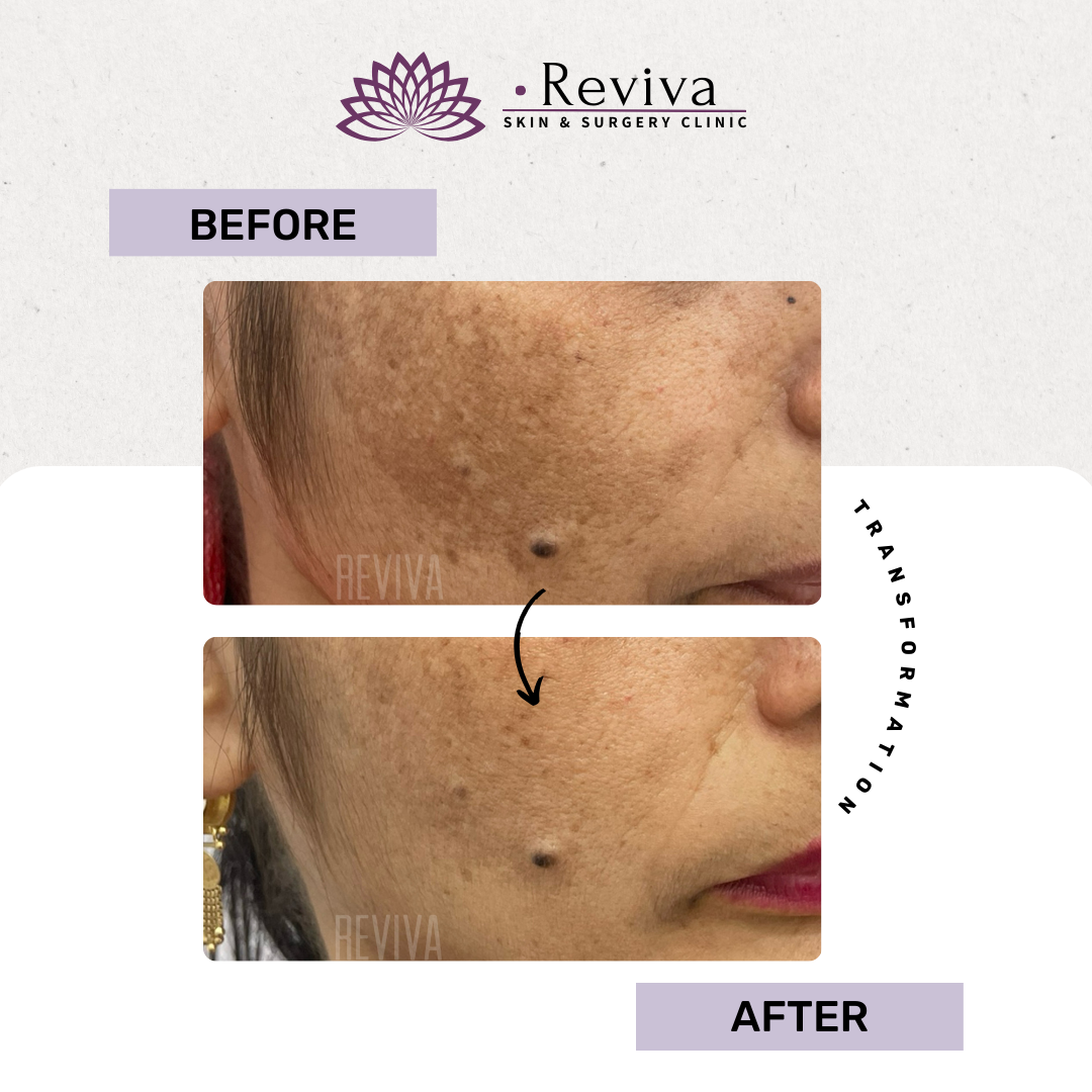 Pigmentation treatment before and after