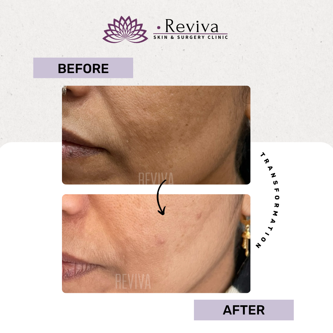 Pigmentation treatment before and after