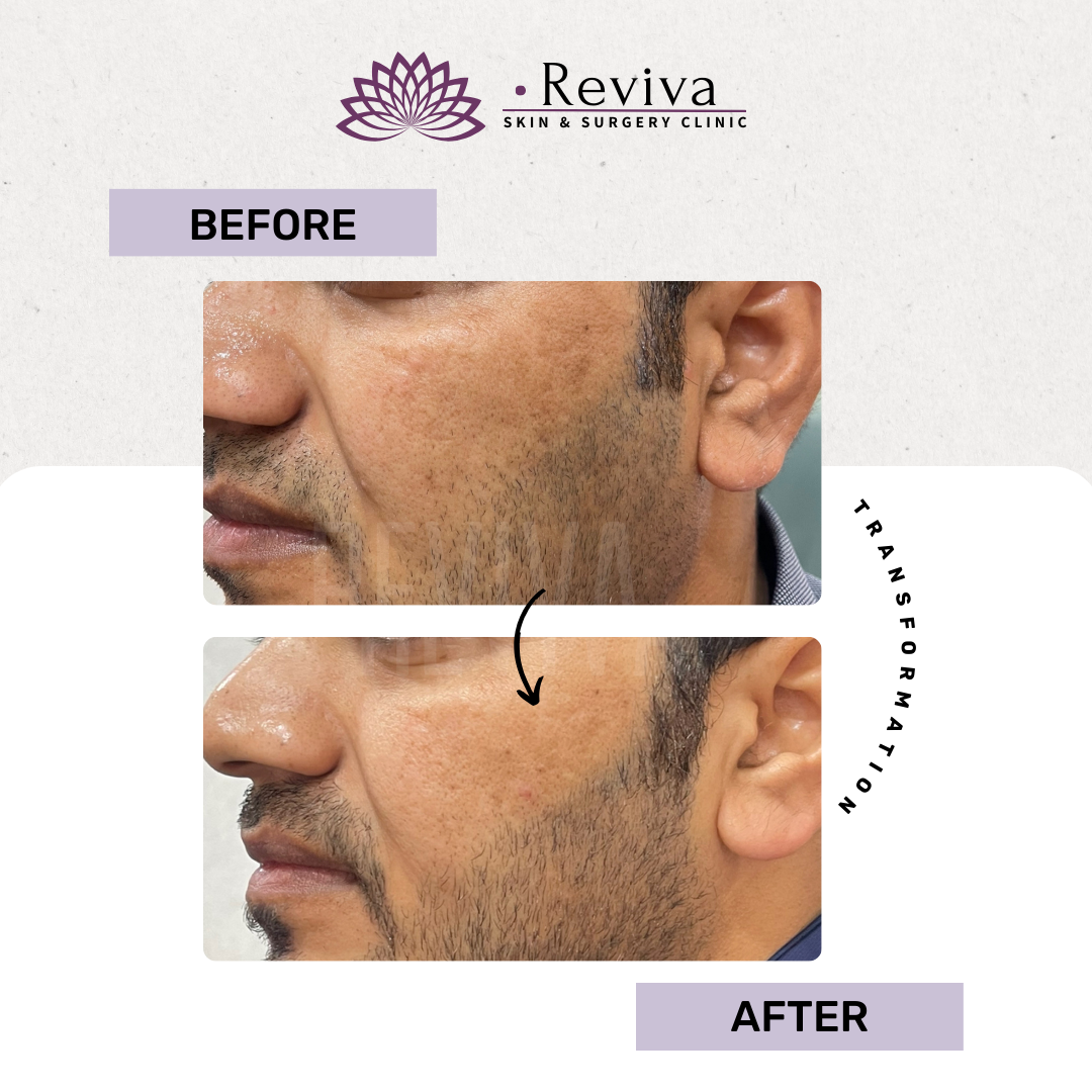 Pigmentation treatment before and after