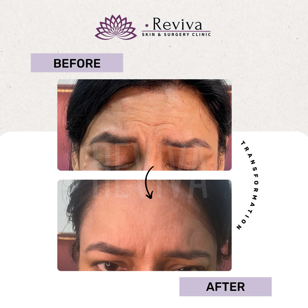 Anti-ageing treatment before and after