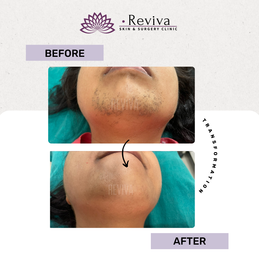 Laser hair removal before and after
