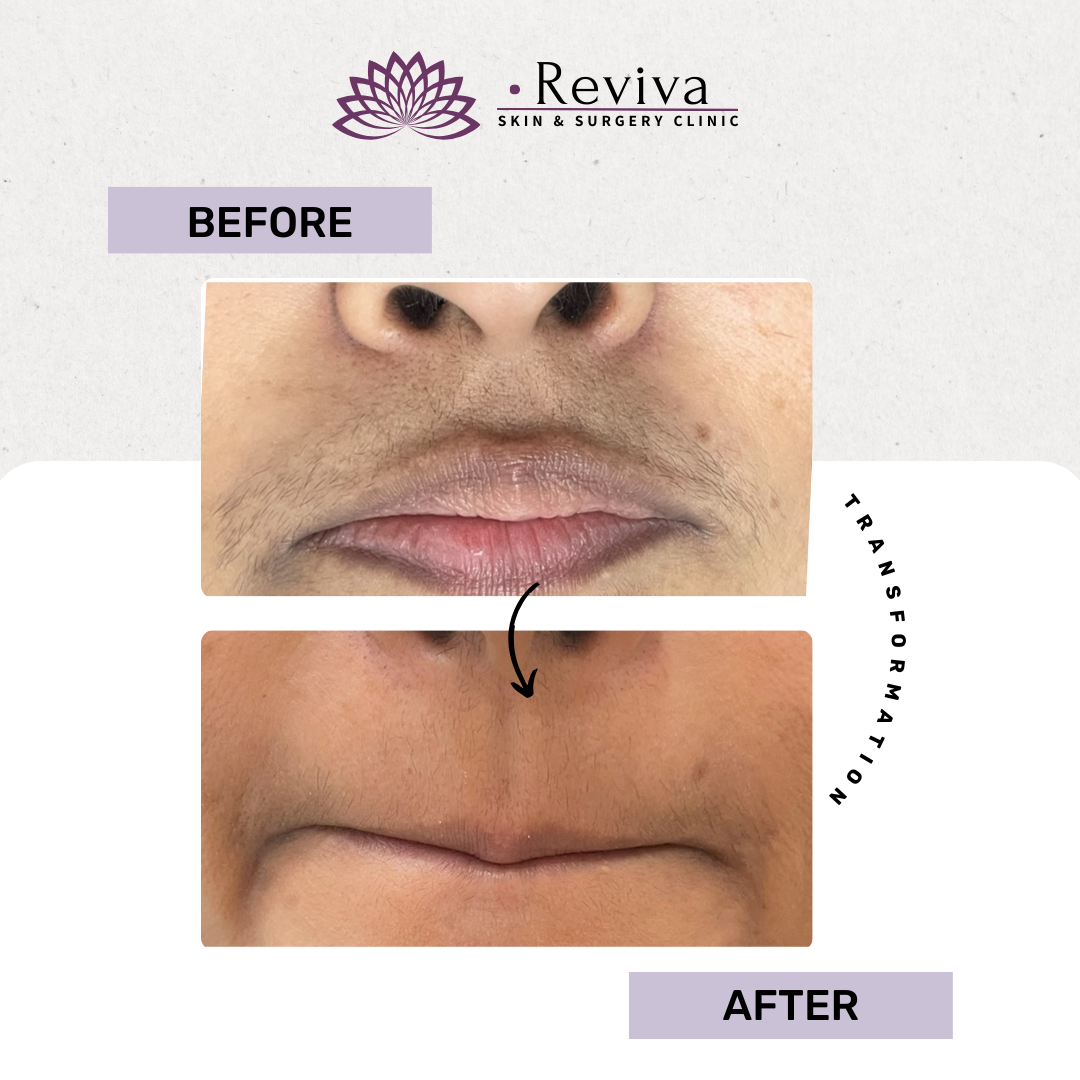 Laser hair removal before and after