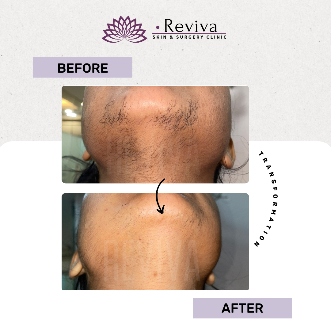 Laser hair removal before and after