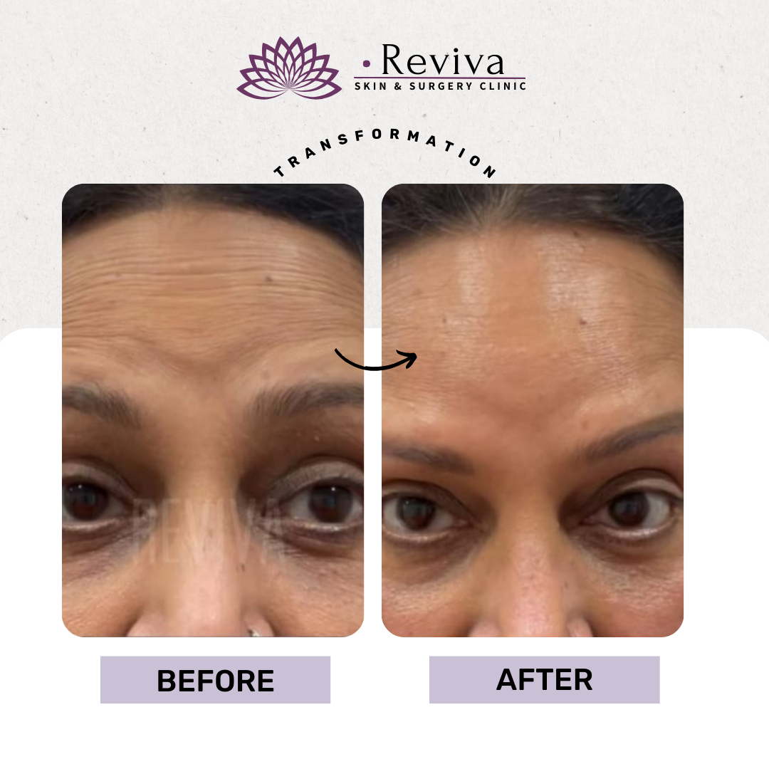 Anti-ageing treatment before and after