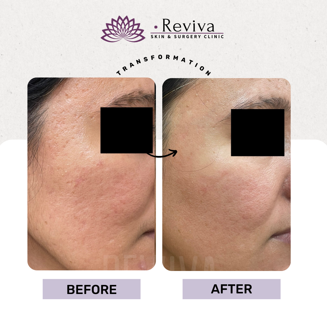 Acne scar treatment before and after