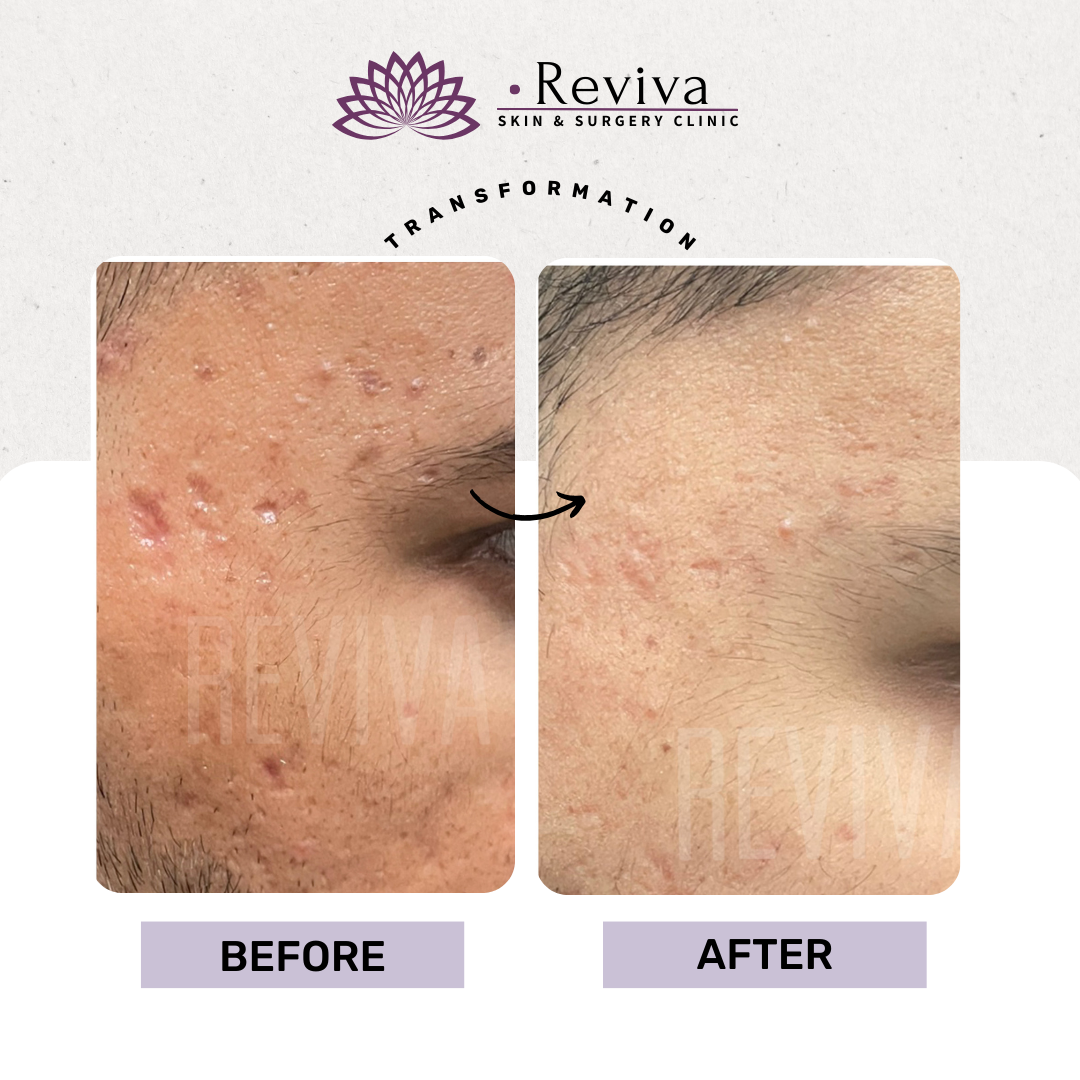 Acne scar treatment before and after