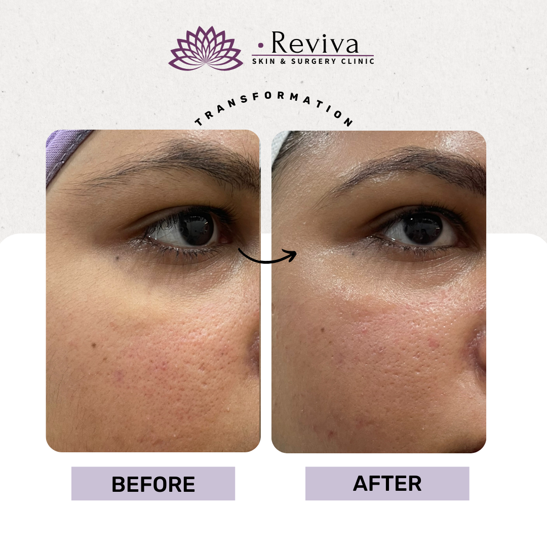 Open pores treatment before and after