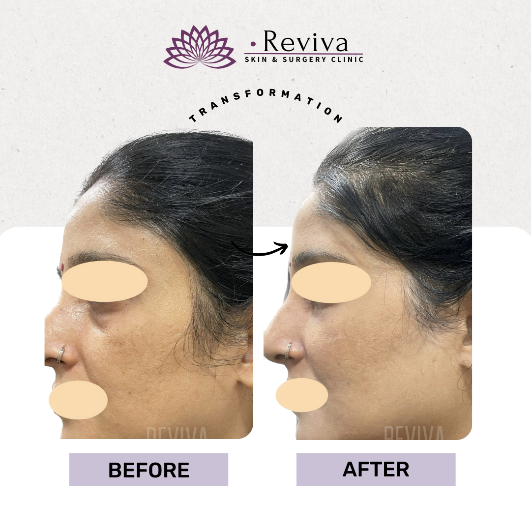 Anti-ageing treatment before and after