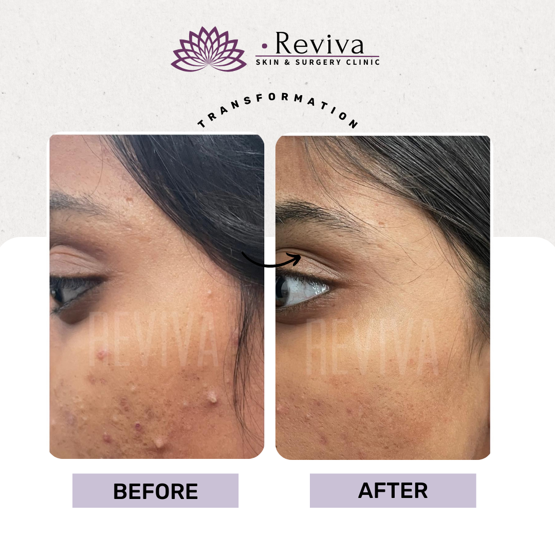 Acne treatment before and after
