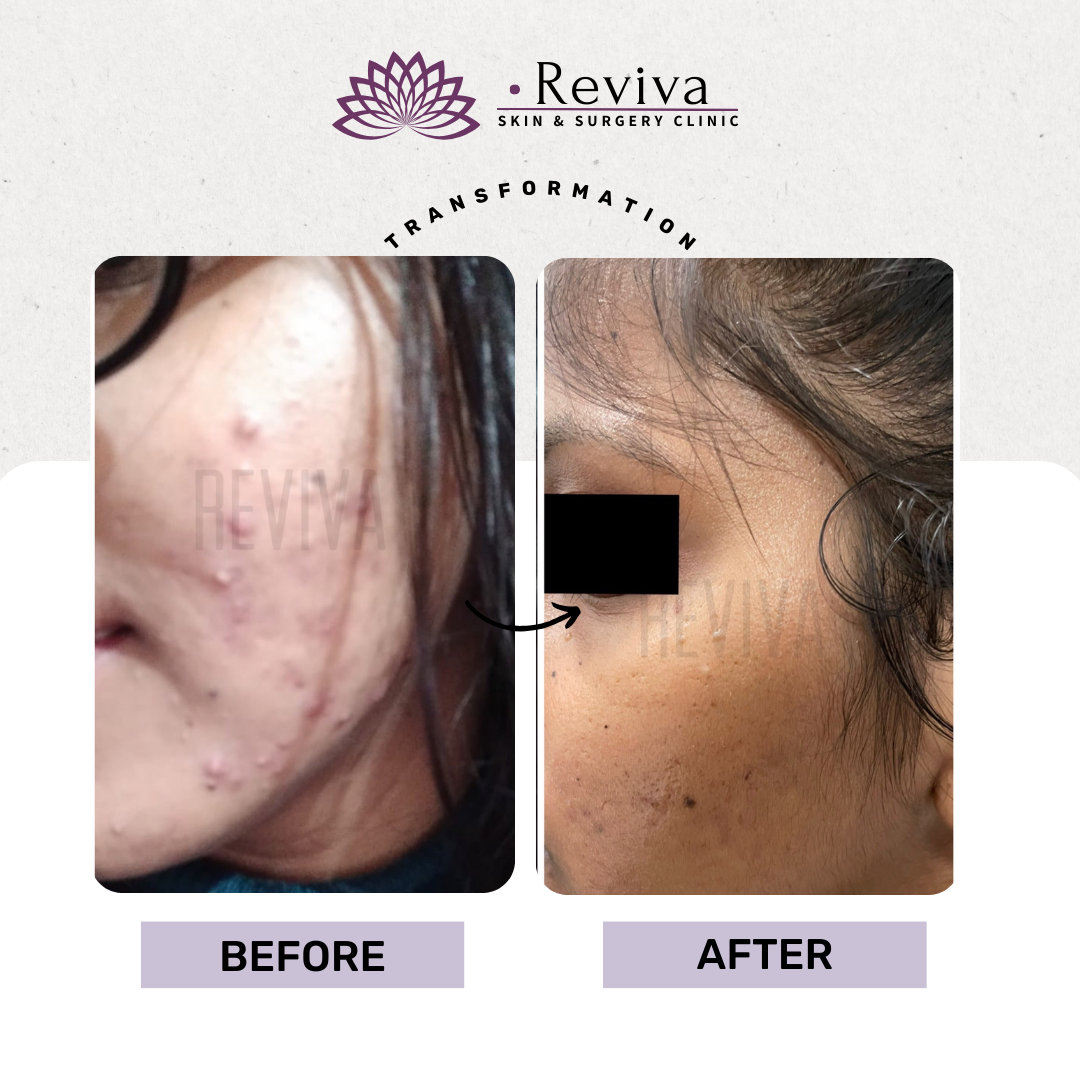 Acne treatment before and after