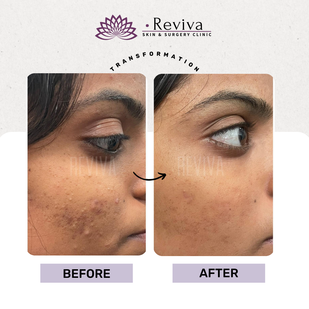 Acne treatment before and after