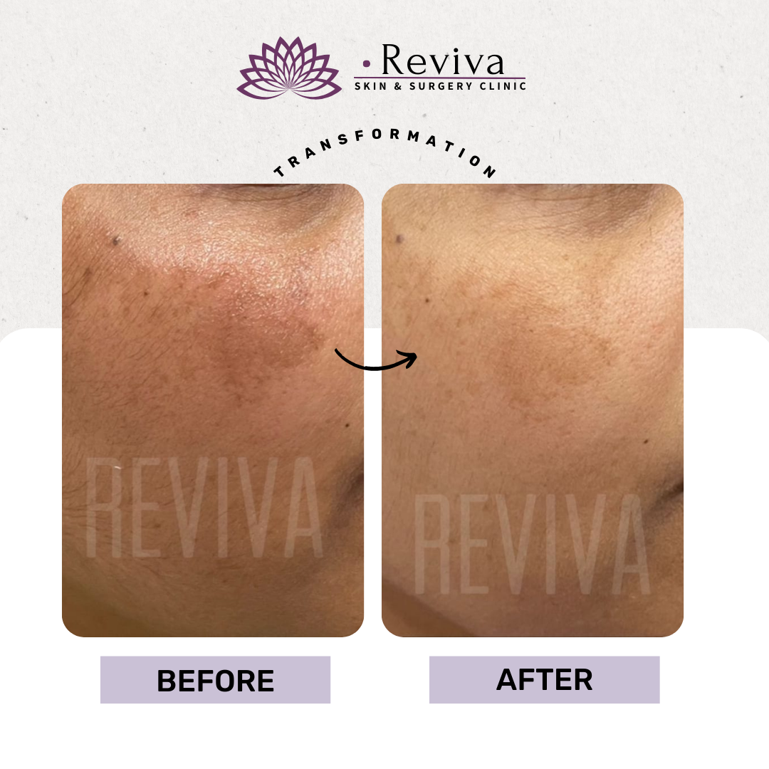 Pigmentation treatment before and after