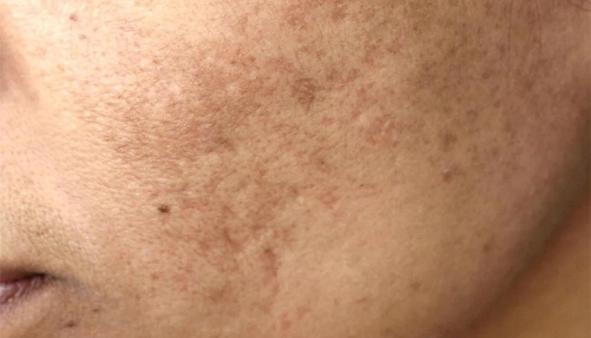 Pigmentation Treatment